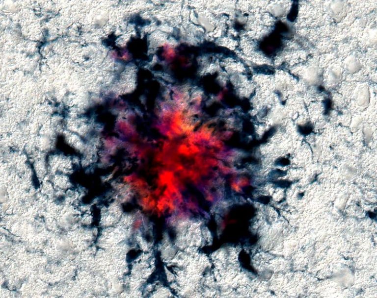 Další skrytá autoimunitní porucha? Neurovědci přišli s teorií, že si Alzheimerovu nemoc způsobuje tělo samo